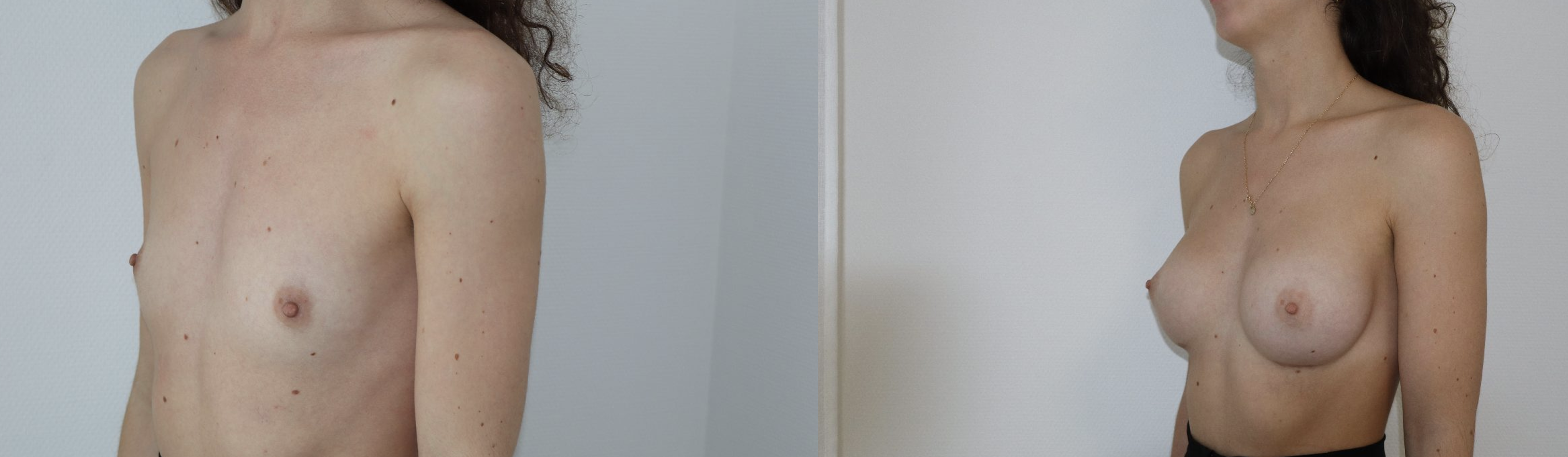 Avant/Après prothèses mammaires